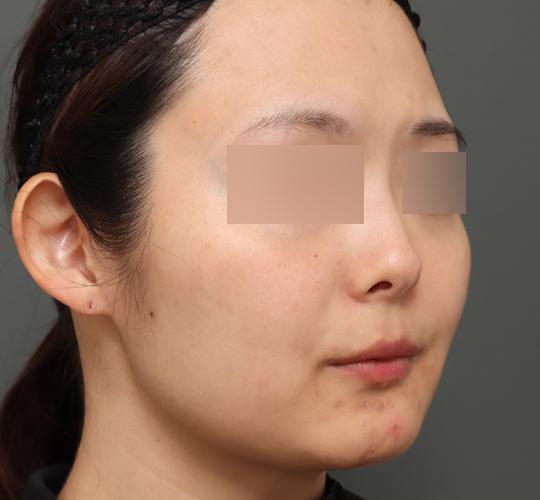 30代女性のボルニューマー Before 症例写真