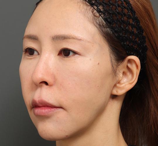 40代女性のボルニューマー After 症例写真