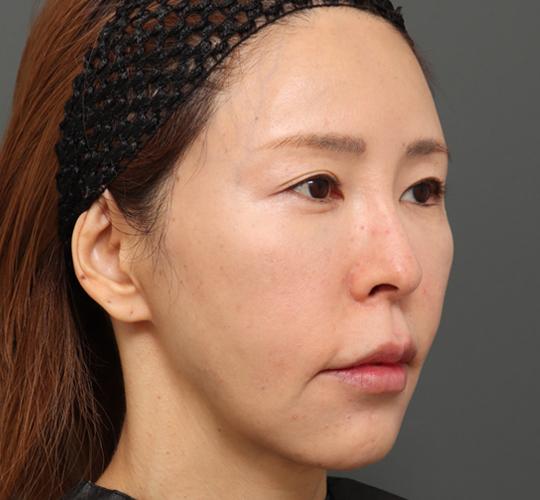 40代女性のボルニューマー After 症例写真