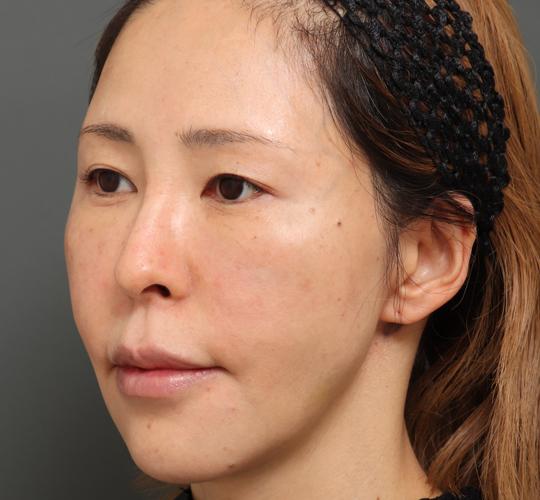 40代女性のボルニューマー Before 症例写真