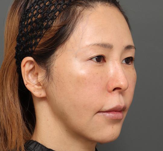 40代女性のボルニューマー Before 症例写真