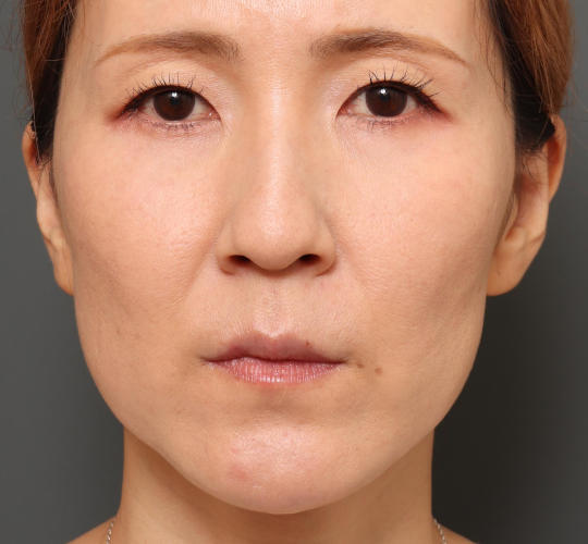 40代女性のハムラ法（目の下のたるみ取り） After 症例写真