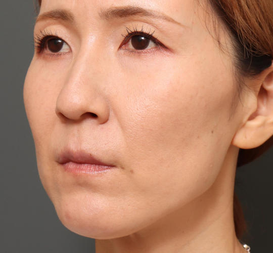 40代女性のハムラ法（目の下のたるみ取り） After 症例写真