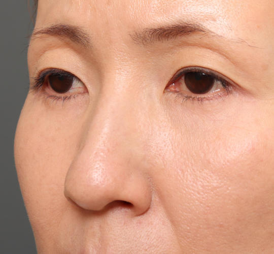 40代女性のハムラ法（目の下のたるみ取り） After 症例写真