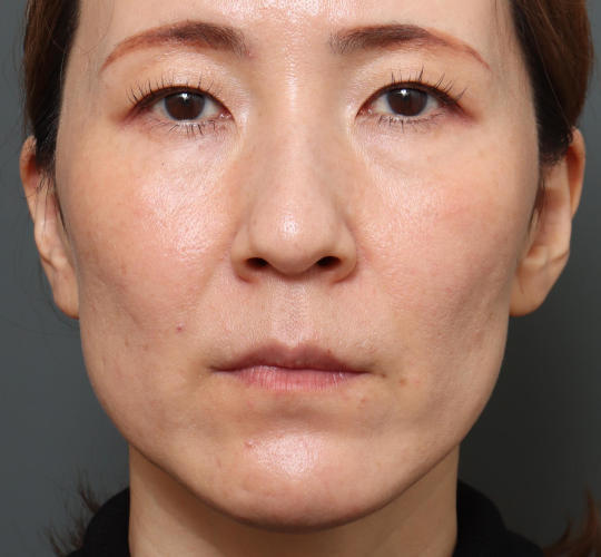 40代女性のハムラ法（目の下のたるみ取り） Before 症例写真