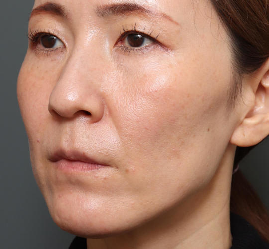 40代女性のハムラ法（目の下のたるみ取り） Before 症例写真