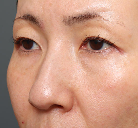 40代女性のハムラ法（目の下のたるみ取り） Before 症例写真