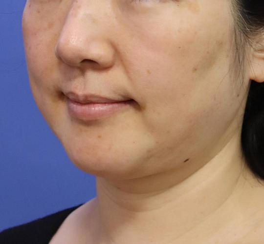 40代女性の顔の脂肪吸引  After 症例写真