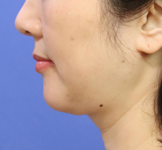 40代女性の顔の脂肪吸引  After 症例写真