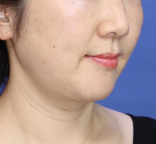 40代女性のシワ・たるみ After 症例写真