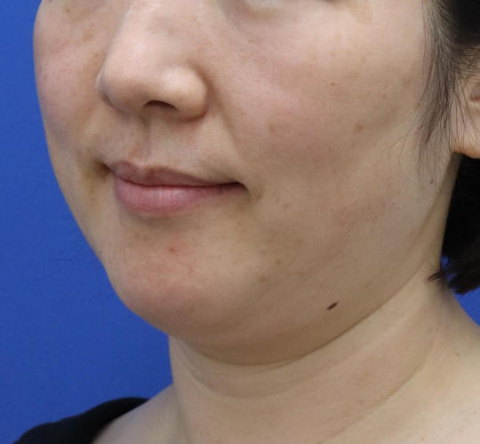 40代女性の顔の脂肪吸引  Before 症例写真