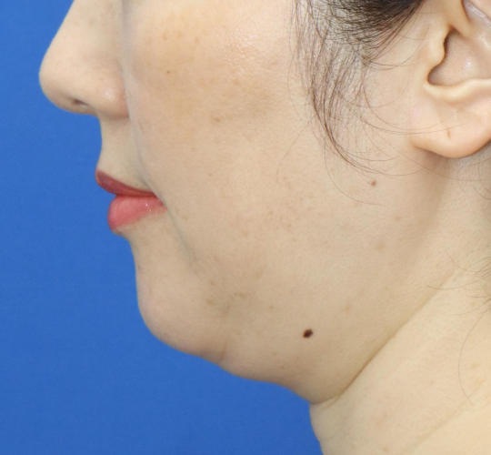 40代女性の顔の脂肪吸引  Before 症例写真