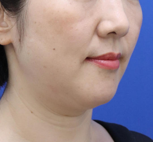 40代女性のシワ・たるみ Before 症例写真