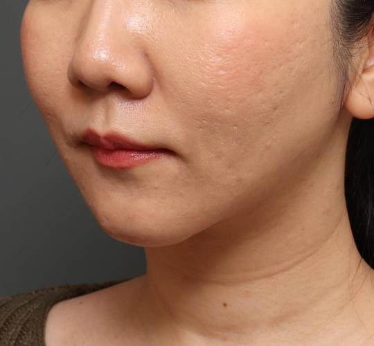 30代女性のVOVリフトプレミアム After 症例写真