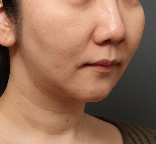 30代女性の顔の脂肪吸引  After 症例写真