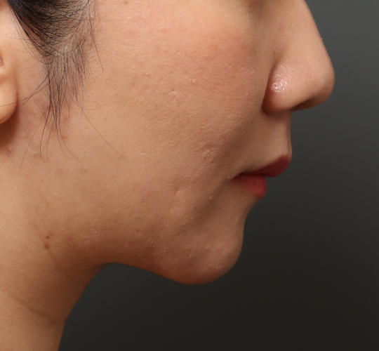 30代女性の顔の脂肪吸引  After 症例写真