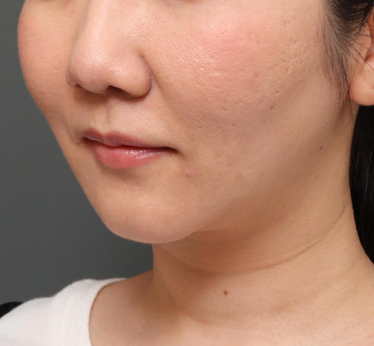 30代女性のVOVリフトプレミアム Before 症例写真