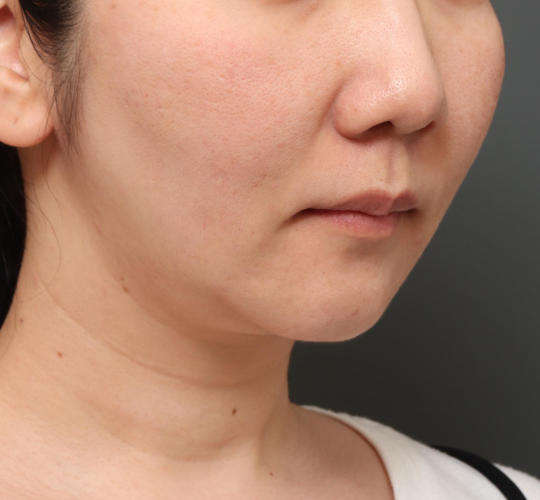 30代女性の顔の脂肪吸引  Before 症例写真