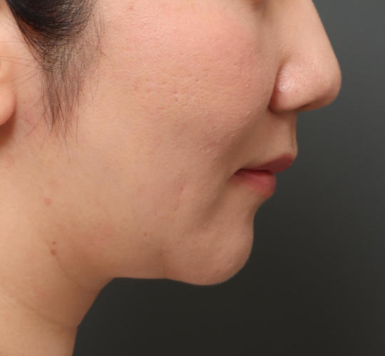 30代女性の顔の脂肪吸引  Before 症例写真