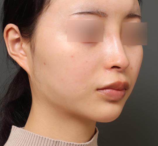 20代女性のVOVリフトプレミアム After 症例写真