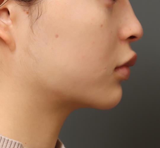 20代女性のVOVリフトプレミアム After 症例写真