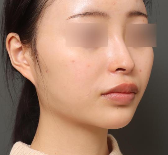 20代女性のVOVリフトプレミアム Before 症例写真