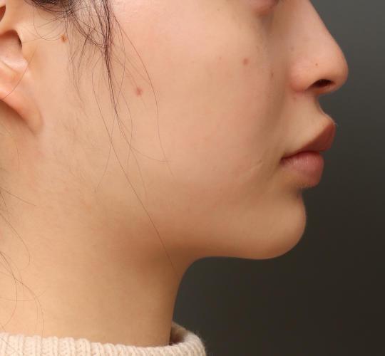 20代女性のVOVリフトプレミアム Before 症例写真