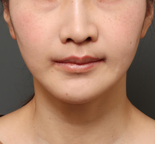 30代女性の人中短縮（リップリフト） After 症例写真
