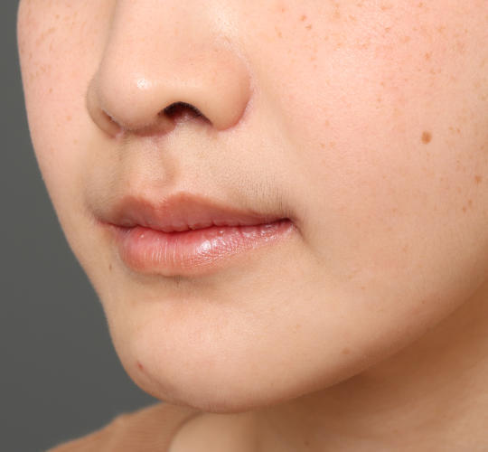 30代女性の人中短縮（リップリフト） After 症例写真