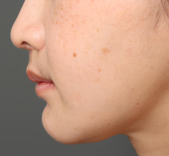 30代女性の人中短縮（リップリフト） After 症例写真