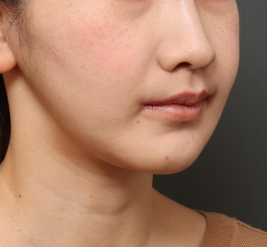 30代女性の鼻の整形 After 症例写真