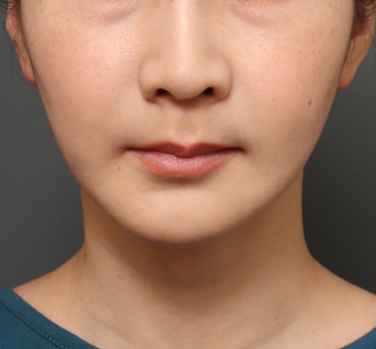 30代女性の人中短縮（リップリフト） Before 症例写真