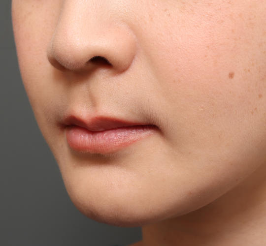 30代女性の人中短縮（リップリフト） Before 症例写真