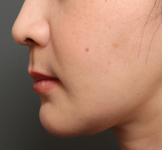 30代女性の人中短縮（リップリフト） Before 症例写真