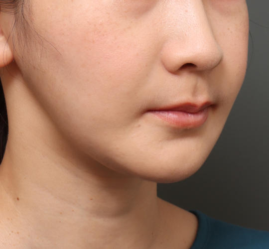 30代女性の鼻の整形 Before 症例写真