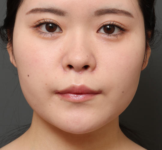 20代女性の人中短縮（リップリフト） After 症例写真