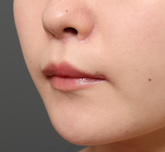 20代女性の人中短縮（リップリフト） After 症例写真