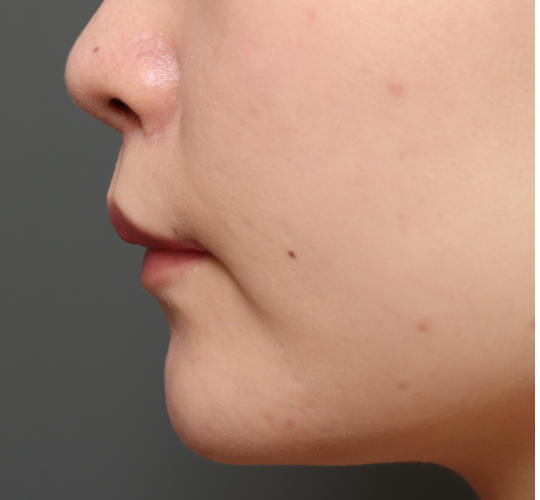 20代女性の人中短縮（リップリフト） After 症例写真