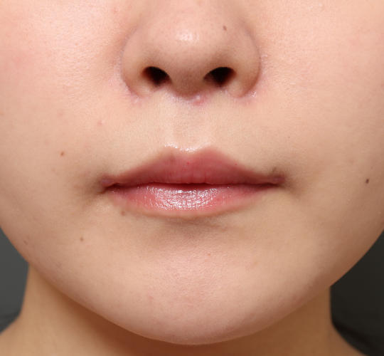 20代女性の人中短縮（リップリフト） After 症例写真