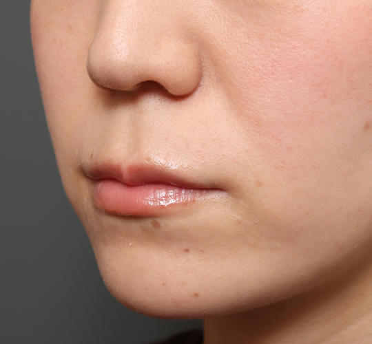 20代女性の人中短縮(リップリフト) Before 症例写真