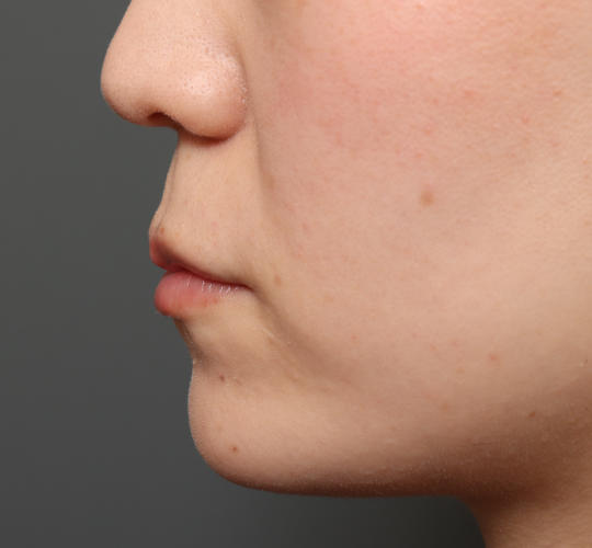 20代女性の人中短縮(リップリフト) Before 症例写真