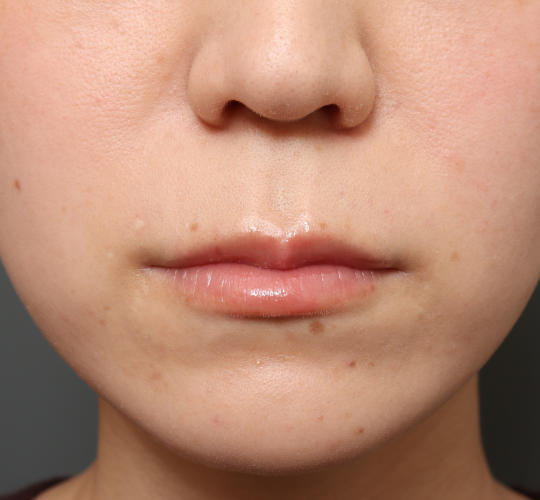 20代女性の人中短縮(リップリフト) Before 症例写真