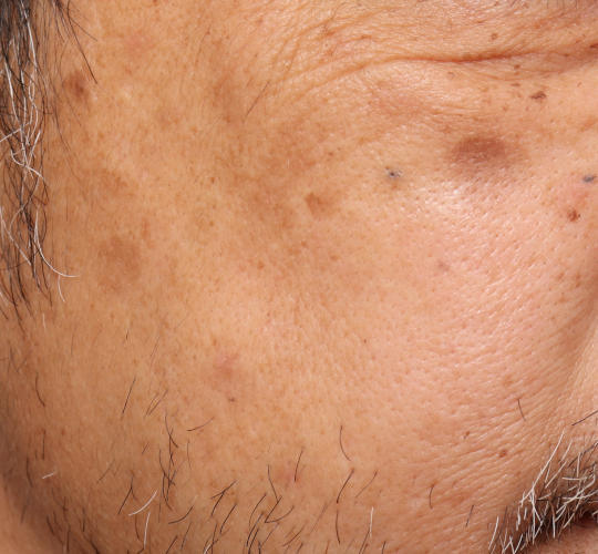 50代男性のピコシュア After 症例写真