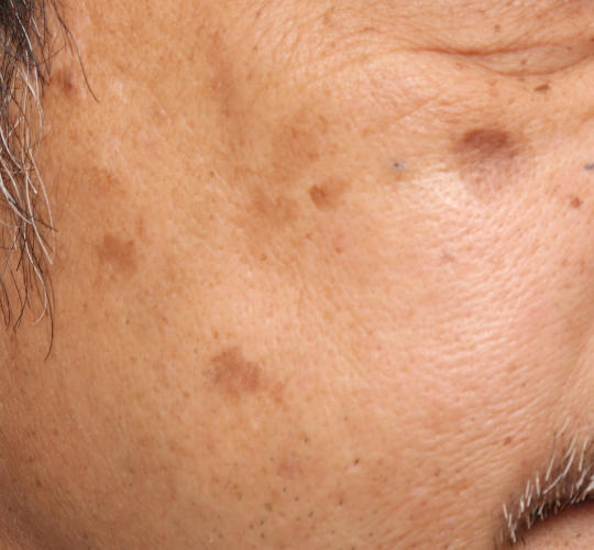 50代男性のピコシュア Before 症例写真