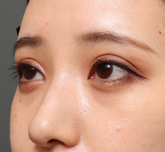 20代女性の目つき矯正 After 症例写真