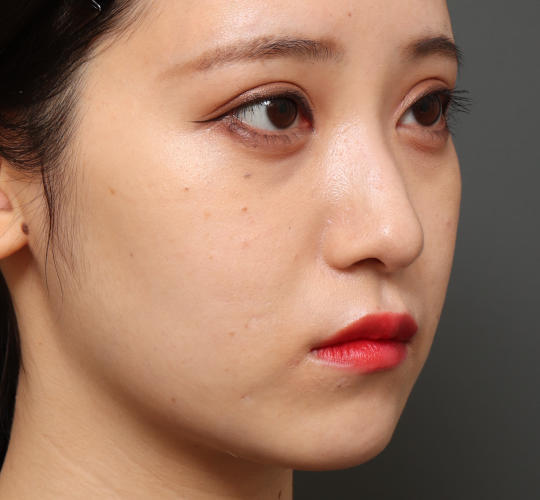 20代女性の目つき矯正 After 症例写真