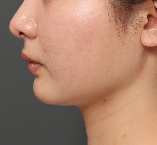 20代女性の顔の脂肪吸引  After 症例写真