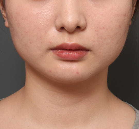 20代女性の顔の脂肪吸引  Before 症例写真