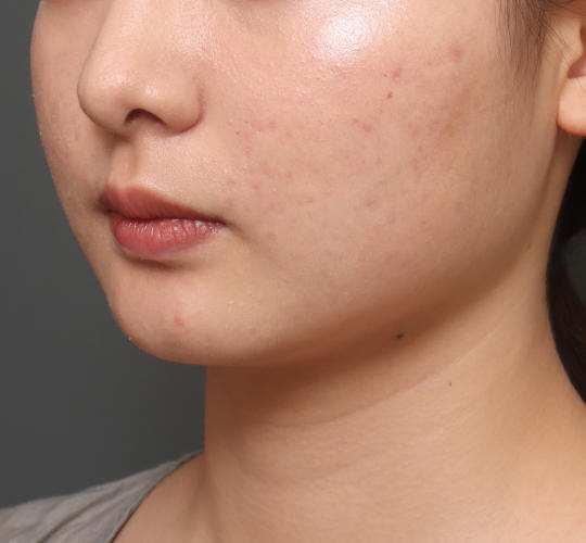 20代女性の顔の脂肪吸引  Before 症例写真