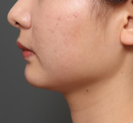 20代女性の顔の脂肪吸引  Before 症例写真